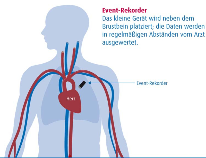 Abbildung: Herz-Event-Rekorder